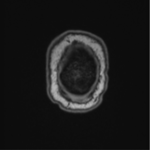 File:Cerebellar hemangioblastomas and pituitary adenoma (Radiopaedia 85490-101176 Coronal T1 8).png