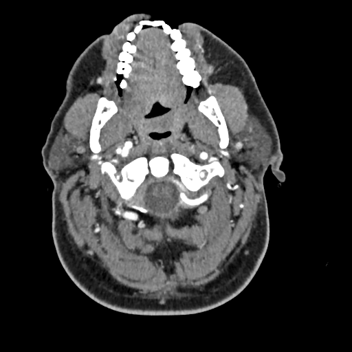 Cerebellar infarct due to vertebral artery dissection with posterior fossa decompression (Radiopaedia 82779-97029 C 62).png