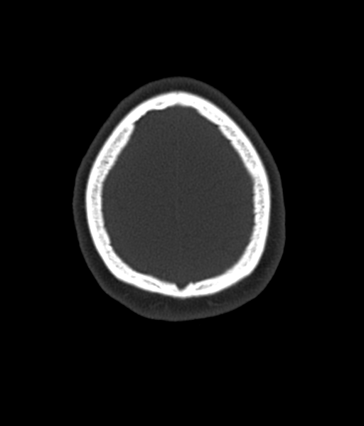 File:Cerebellar metastases - colorectal adenocarcinoma (Radiopaedia 40947-43652 AX Bone C- 2.0 MPR 58).png