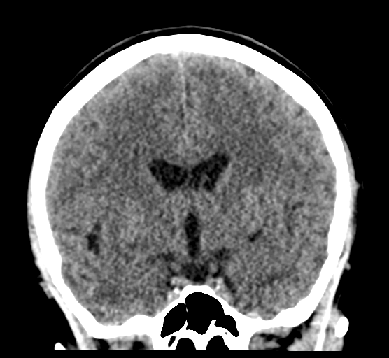 Cerebellar metastases - colorectal adenocarcinoma (Radiopaedia 40947-43652 Coronal non-contrast 45).png
