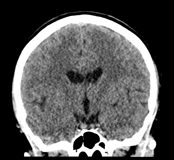 Cerebellar metastases - colorectal adenocarcinoma (Radiopaedia 40947-43652 Coronal non-contrast 46).png
