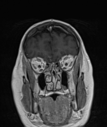 File:Cerebellar metastasis (Radiopaedia 54578-60810 Coronal T1 C+ 7).png