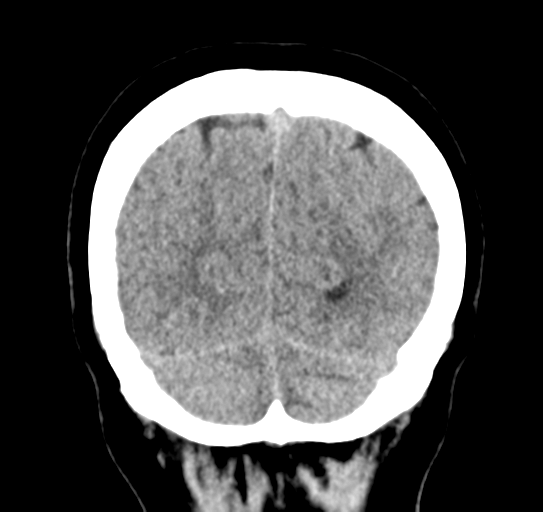 Cerebellar metastasis (Radiopaedia 54578-60812 Coronal non-contrast 51).png