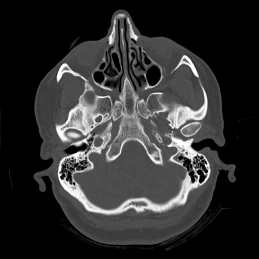Cerebellar metastasis (cystic appearance) (Radiopaedia 41395-44258 Axial bone window 10).png