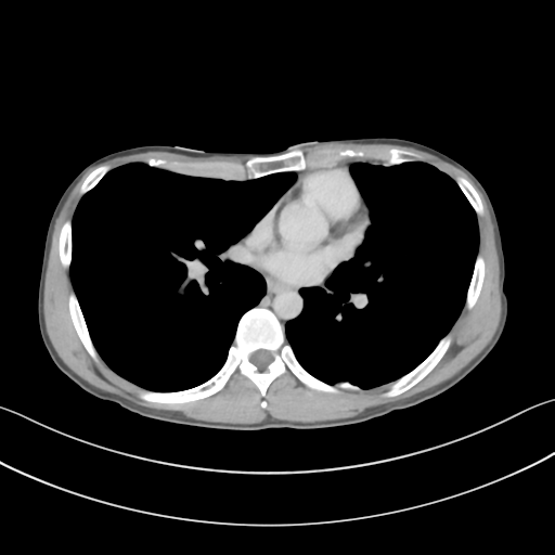 Cerebellar metastasis - adenocarcinoma lung (Radiopaedia 63184-71717 Axial C+ delayed 37).png