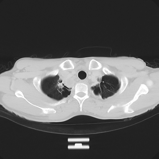 Cerebellar metastasis - adenocarcinoma lung (Radiopaedia 63184-71717 Axial lung window 11).png