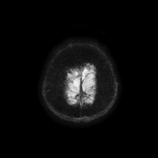 Cerebellar metastasis of pulmonary adenocarcinoma, cavernous venous malformation, and developmental venous anomaly (Radiopaedia 85827-101661 Axial SWI 6).jpg