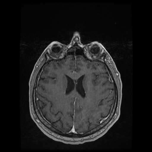 Cerebellar metastasis of pulmonary adenocarcinoma, cavernous venous malformation, and developmental venous anomaly (Radiopaedia 85827-101661 Axial T1 C+ 64).jpg