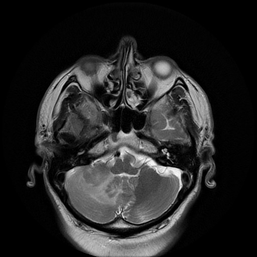 File:Cerebellar metastasis of pulmonary adenocarcinoma, cavernous venous malformation, and developmental venous anomaly (Radiopaedia 85827-101661 Axial T2 9).jpg