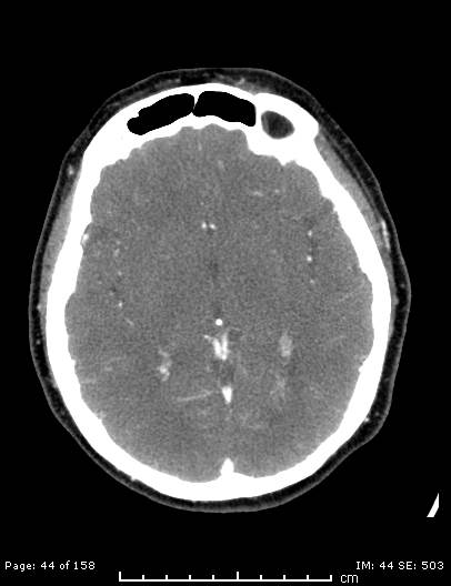 Cerebellar strokes due to intracranial giant cell arteritis (Radiopaedia 68799-78510 CT angiogram 44).jpg
