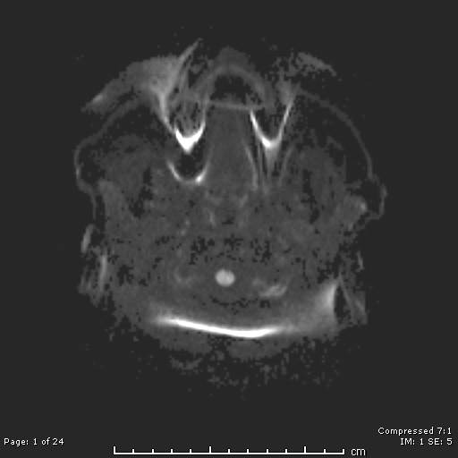 File:Cerebellar strokes due to intracranial giant cell arteritis (Radiopaedia 68799-81713 Axial DWI 1).jpg