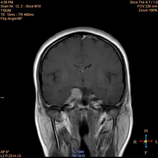 File:Cerebellopontine angle meningioma (Radiopaedia 22488-22525 Coronal T1 C+ 9).jpg