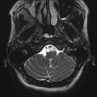 Cerebellopontine angle meningioma (Radiopaedia 72983-83680 Axial FIESTA 2).jpg