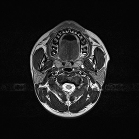 Cerebral abscess (Radiopaedia 24212-24478 Axial T2 3).jpg