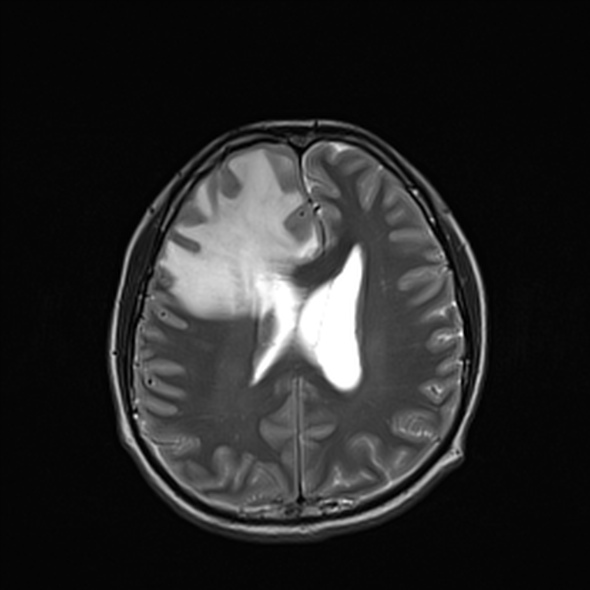 Cerebral abscess (Radiopaedia 24212-24478 Axial T2 40).jpg