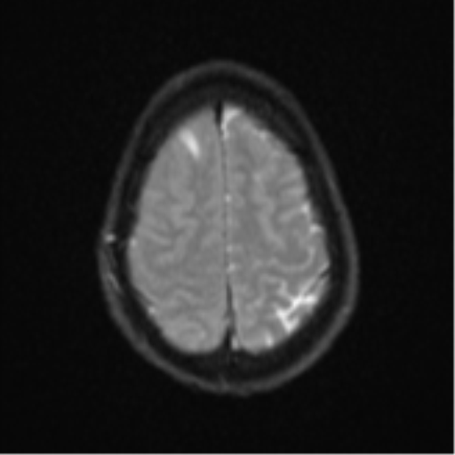 Cerebral abscess (Radiopaedia 60342-68009 Axial DWI 30).png