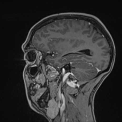 Cerebral abscess (Radiopaedia 60342-68009 J 19).png