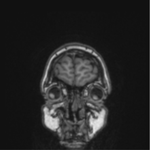 File:Cerebral abscess from pulmonary arteriovenous malformation (Radiopaedia 86275-102291 Coronal T1 82).png
