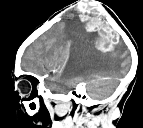 Cerebral abscesses (Radiopaedia 70458-80568 Sagittal Contrast 18).jpg