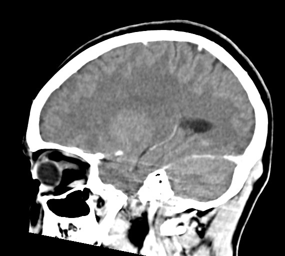 Cerebral abscesses (Radiopaedia 70458-80568 Sagittal Contrast 38).jpg