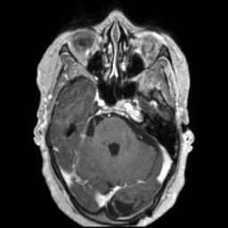 Cerebral amyloid angiopathy (Radiopaedia 29129-29518 Axial T1 C+ 46).jpg
