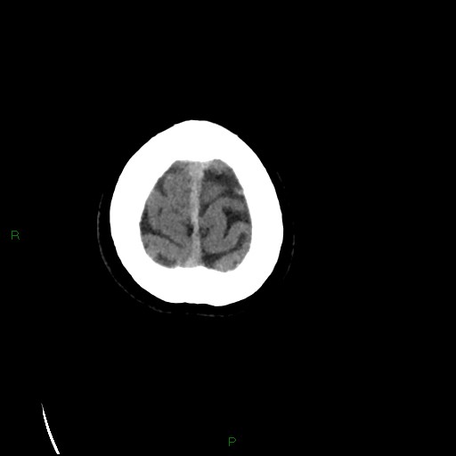 File:Cerebral amyloid angiopathy (Radiopaedia 77506-89665 Axial non-contrast 104).jpg