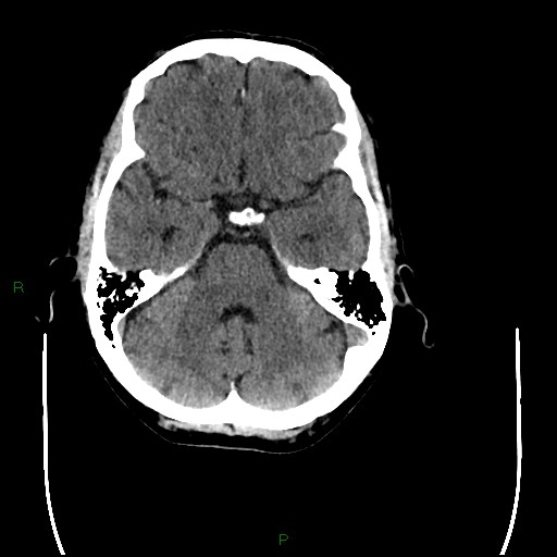 Cerebral amyloid angiopathy (Radiopaedia 77506-89665 Axial non-contrast 32).jpg