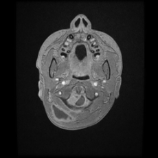 Cerebral and spinal tuberculosis (Radiopaedia 90489-107837 Axial T1 C+ 17).jpg