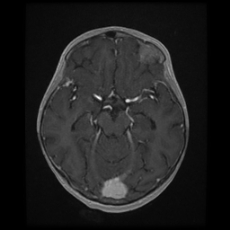 Cerebral and spinal tuberculosis (Radiopaedia 90489-107837 Axial T1 C+ 85).jpg