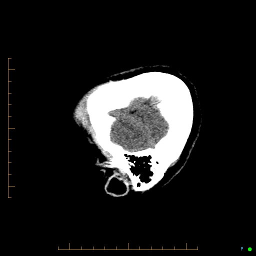Cerebral arteriovenous malformation (AVM) (Radiopaedia 78162-90706 A 8).jpg