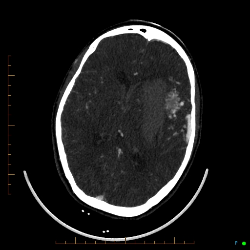 Cerebral arteriovenous malformation (AVM) (Radiopaedia 78162-90706 Axial CTA 153).jpg