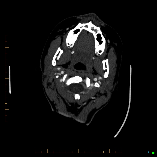 Cerebral arteriovenous malformation (AVM) (Radiopaedia 78162-90706 Axial CTA 20).jpg