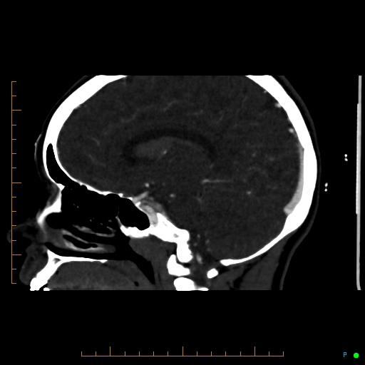 Cerebral arteriovenous malformation (AVM) (Radiopaedia 78162-90706 Sagittal CTA 46).jpg