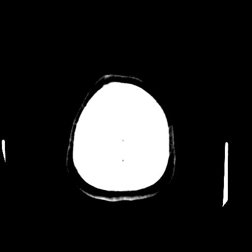 Cerebral arteriovenous malformation (Radiopaedia 28518-28759 Axial non-contrast 71).jpg