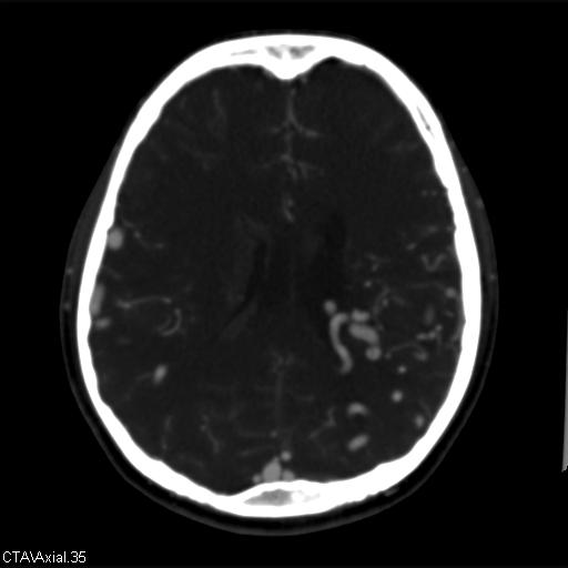 File:Cerebral arteriovenous malformation (Radiopaedia 28518-28759 B 35).jpg