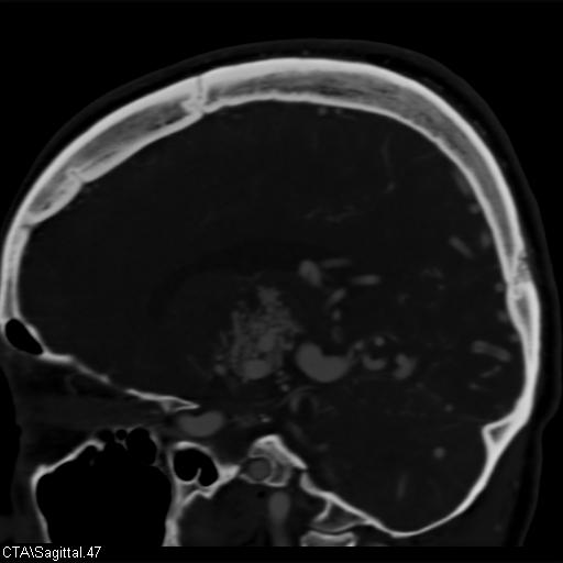 File:Cerebral arteriovenous malformation (Radiopaedia 28518-28759 D 44).jpg