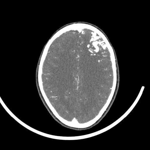 Cerebral arteriovenous malformation (Radiopaedia 29531-30031 E 74).jpg