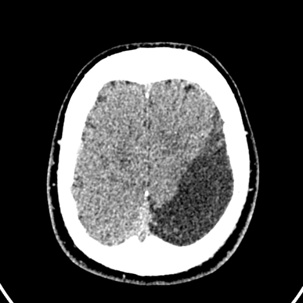 File:Cerebral arteriovenous malformation (Radiopaedia 37182-39012 Axial non-contrast 40).jpg