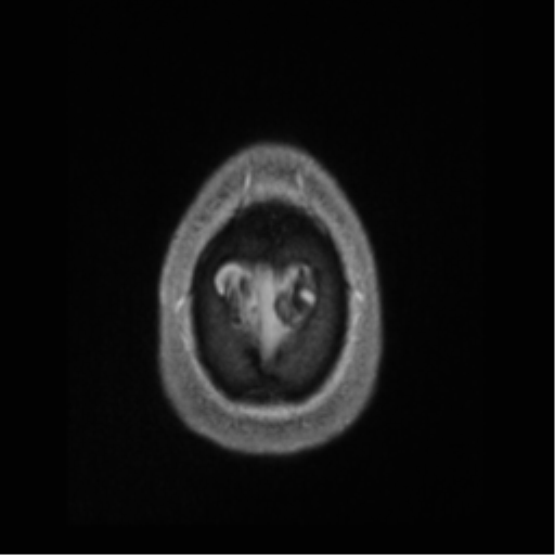 Cerebral arteriovenous malformation (Radiopaedia 55798-62372 Axial T1 C+ 75).png