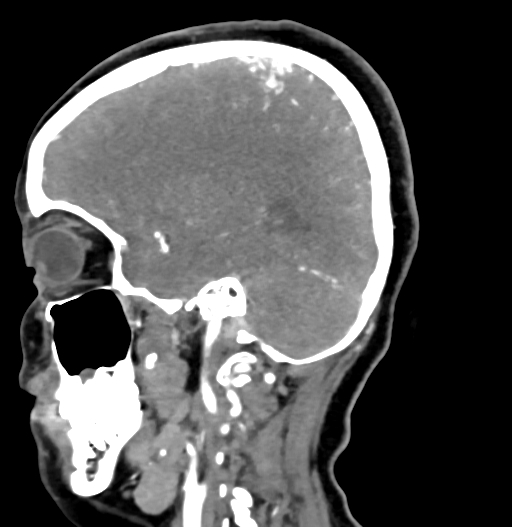 Cerebral arteriovenous malformation (Radiopaedia 73830-84645 D 64).jpg