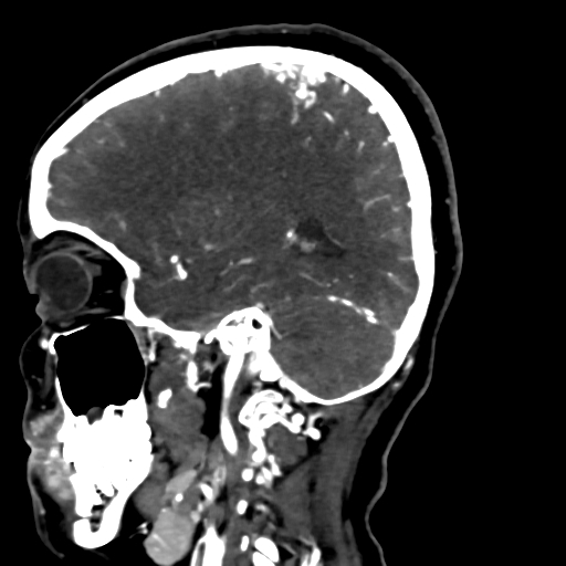 Cerebral arteriovenous malformation (Radiopaedia 73830-84645 Sagittal C+ delayed 63).jpg