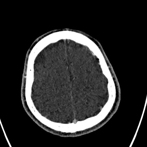 Cerebral arteriovenous malformation (Radiopaedia 78188-90746 Axial C+ delayed 141).jpg