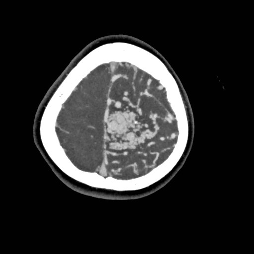 File:Cerebral arteriovenous malformation (Radiopaedia 79677-92888 A 51).jpg