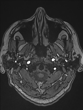 Cerebral arteriovenous malformation (Radiopaedia 84015-99245 Axial TOF 27).jpg
