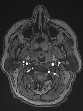 Cerebral arteriovenous malformation (Radiopaedia 84015-99245 Axial TOF 4).jpg
