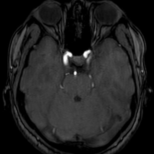 Cerebral arteriovenous malformation at posterior body of corpus callosum (Radiopaedia 74111-84925 Axial MRA 63).jpg
