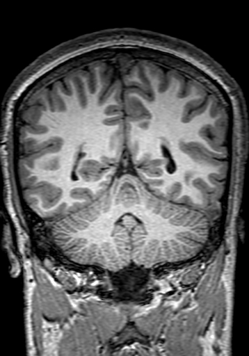 File:Cerebral arteriovenous malformation at posterior body of corpus callosum (Radiopaedia 74111-84925 Coronal T1 242).jpg