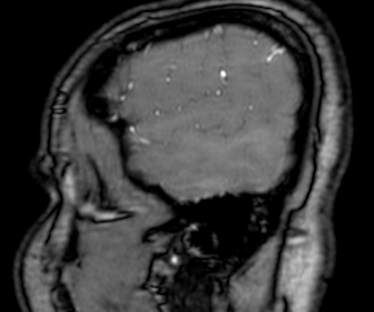 Cerebral arteriovenous malformation at posterior body of corpus callosum (Radiopaedia 74111-84925 J 17).jpg