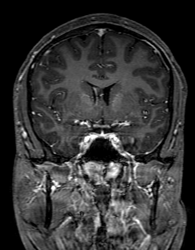 Cerebral arteriovenous malformation at posterior body of corpus callosum (Radiopaedia 74111-84925 K 148).jpg