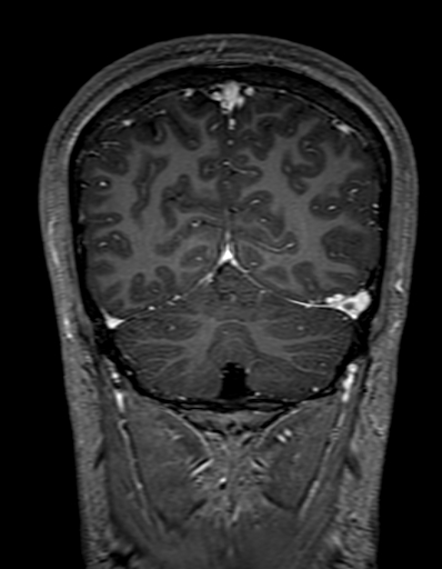 Cerebral arteriovenous malformation at posterior body of corpus callosum (Radiopaedia 74111-84925 K 297).jpg